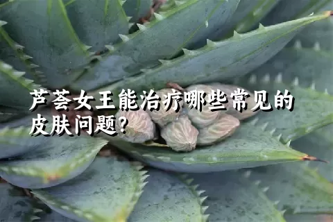 芦荟女王能治疗哪些常见的皮肤问题？